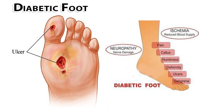 diabetics feet pictures